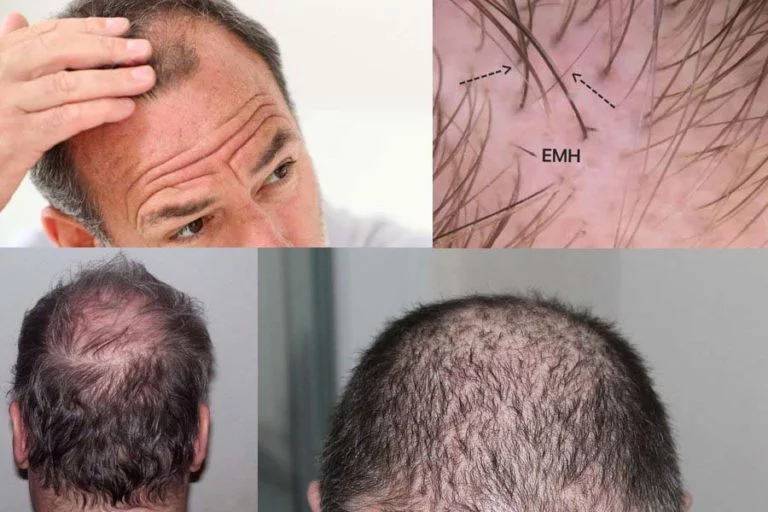 Alopecia, todo sobre la caída del cabello - Medican Clinics