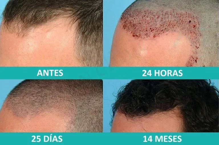 Proceso de Trasplante capilar - Tecnica FUE Tricología - Medican Clinics