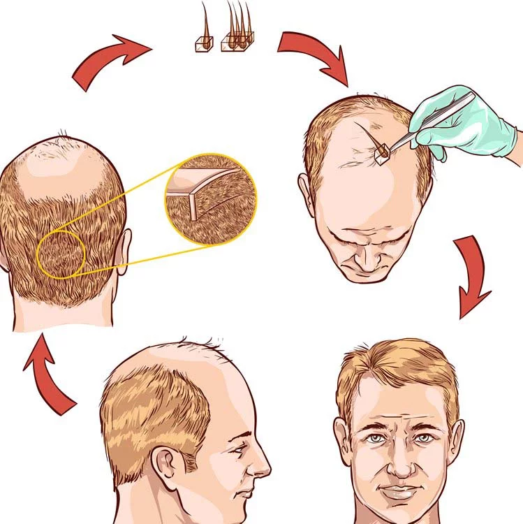 Proceso de Trasplante capilar - Tecnica FUE Tricología - Medican Clinics