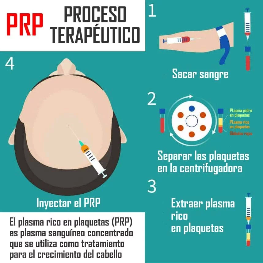 PRP - Plasma Rico en Plaquetas para Trasplante Capilar - Medican Clinics