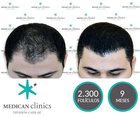 2300 Folículos - Trasplante de cabello - Medican Clinics 2300 Folículos - Trasplante de cabello - Medican Clinics