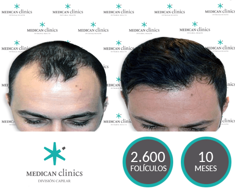 2600 Folículos - Trasplante de cabello - Medican Clinics 2600 Folículos - Trasplante de cabello - Medican Clinics
