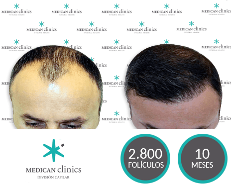 2.800 Folículos - Trasplante de cabello - Medican Clinics 2.800 Folículos - Trasplante de cabello - Medican Clinics