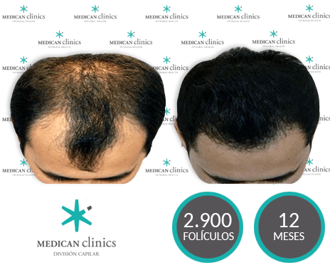2.900 Folículos - Trasplante de pelo - Medican Clinics 2.900 Folículos - Trasplante de pelo - Medican Clinics