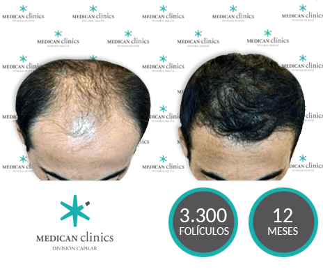 3300 Folículos - Trasplante de pelo - Medican Clinics 3300 Folículos - Trasplante de pelo - Medican Clinics