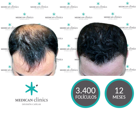 3400 Folículos - Trasplante de pelo - Medican Clinics