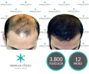 3800 Folículos - Trasplante de pelo - Medican Clinics