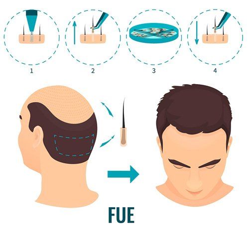 Antes y Después – Trasplante de pelo en Medican Clinics Antes y Después - Trasplante de pelo en Medican Clinics